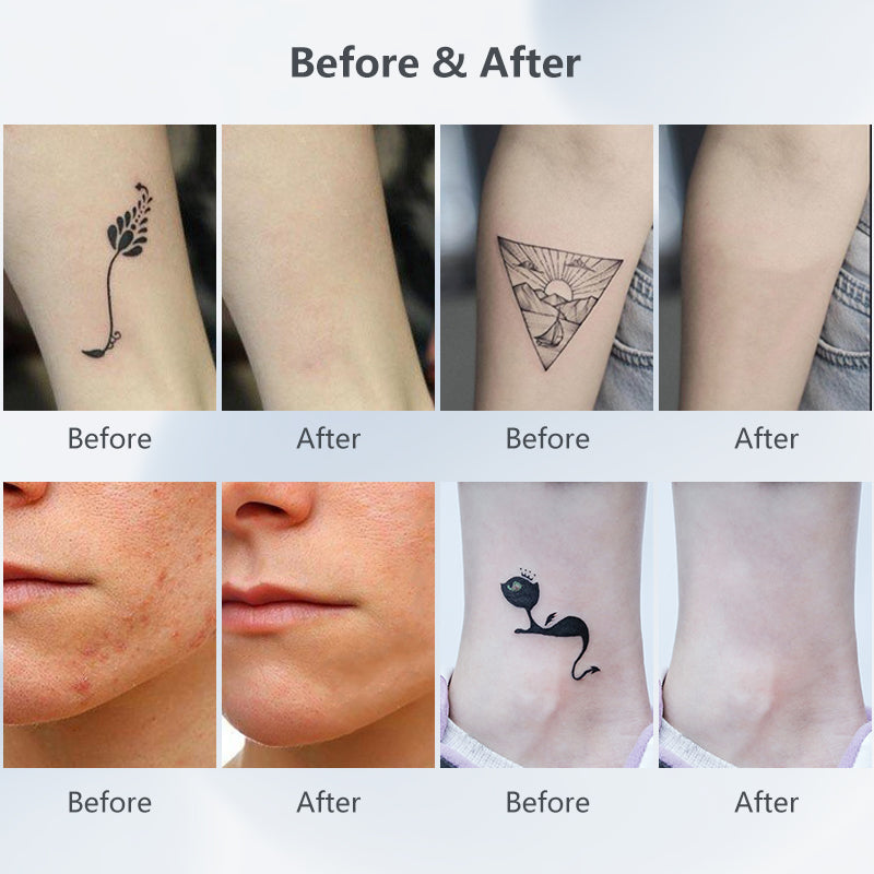 Smart Tattoo Removal Laser Pen - Remove Moles, Freckles, Acne, Tattoo